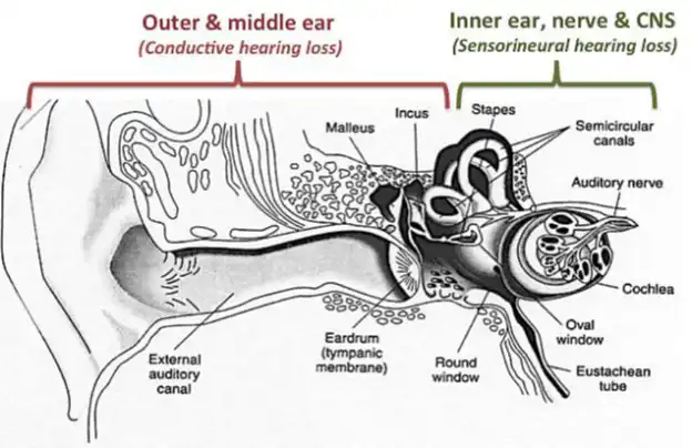 Hearing loss